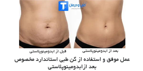 استفاده از گن ابدومینوپلاستی بعد از عمل